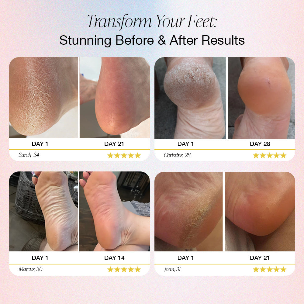 DermaWave™ Electric Foot Callus Remover